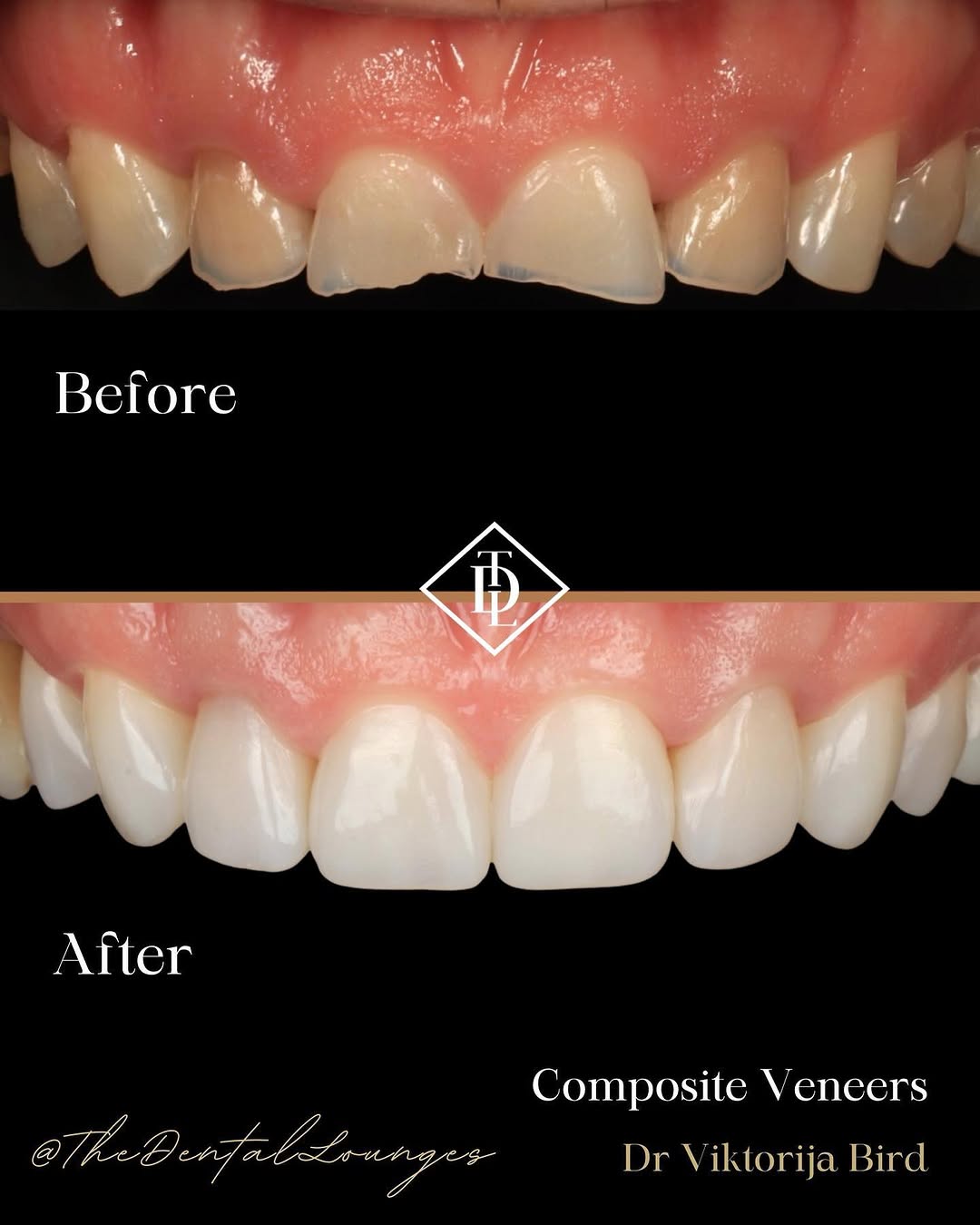 Bespoke composite bonding smile makeover, The Dental Lounges Wimbledon