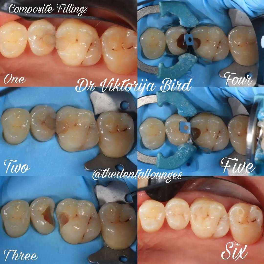 Natural composite fillings before and after, Wimbledon