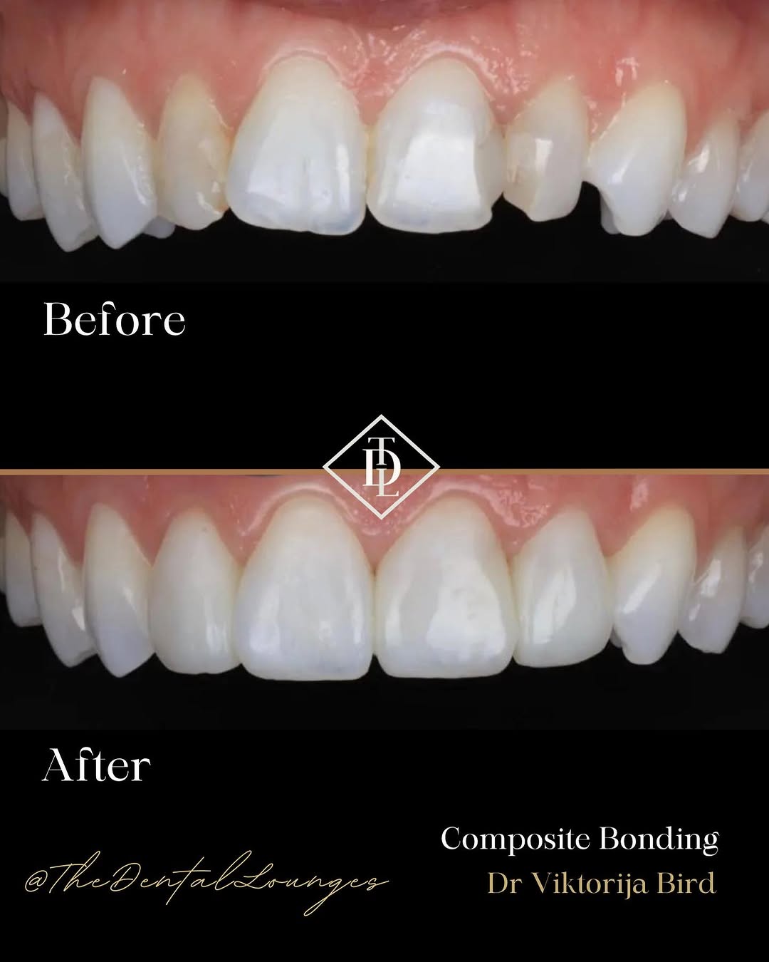 Cosmetic composite bonding result, Wimbledon