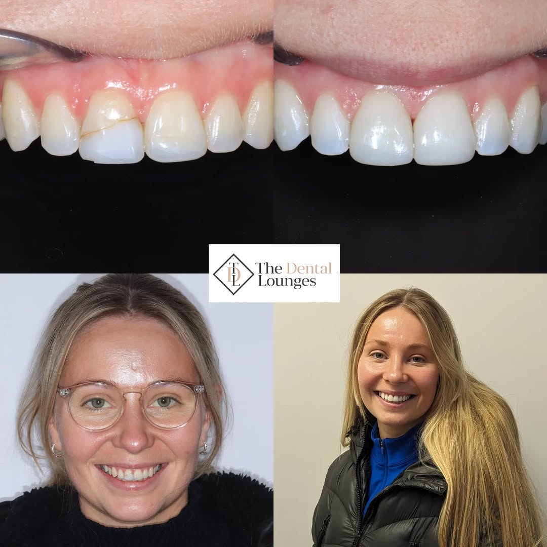 Smile enhancement case at The Dental Lounges Wimbledon