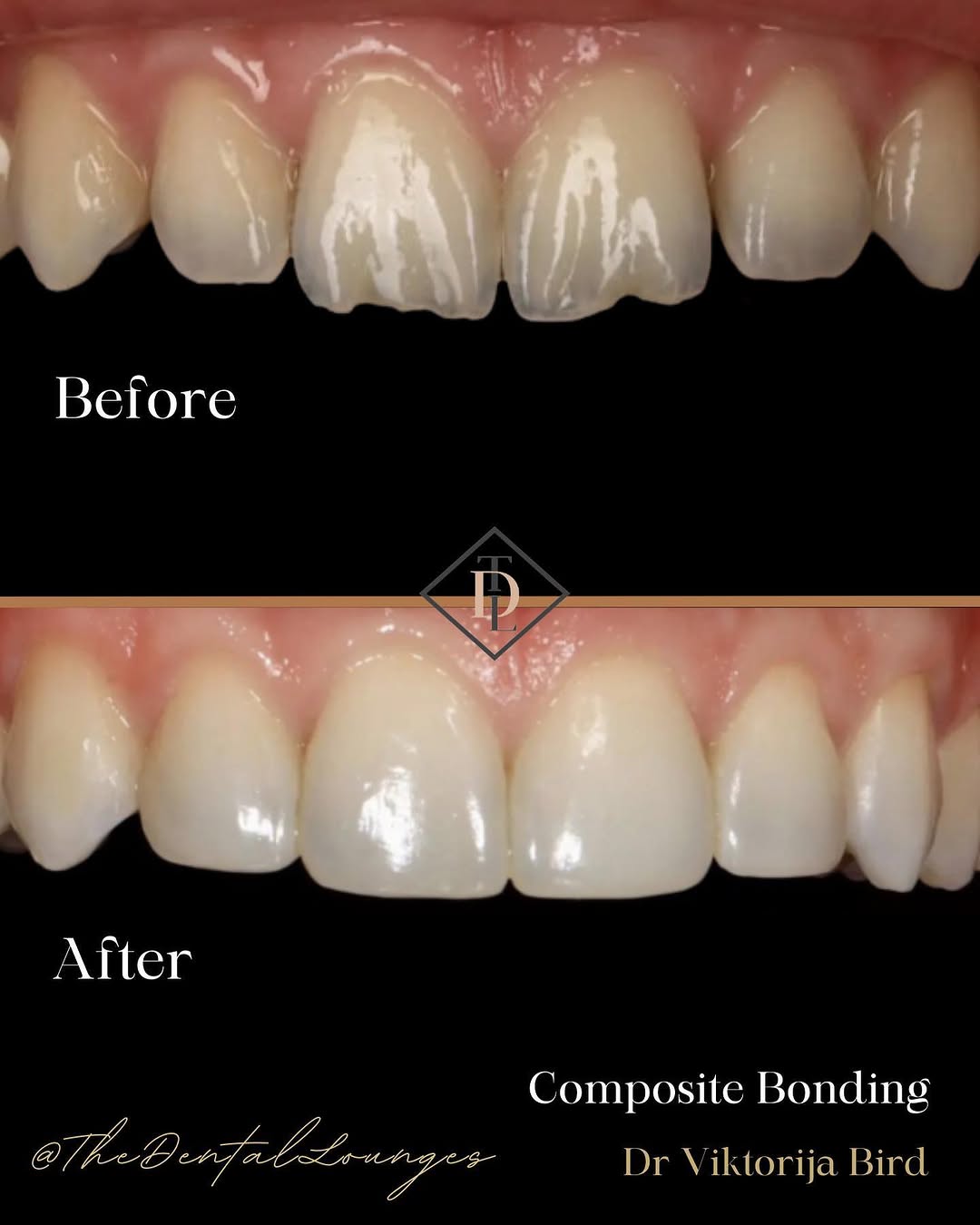 Composite bonding closing gaps before and after, Wimbledon