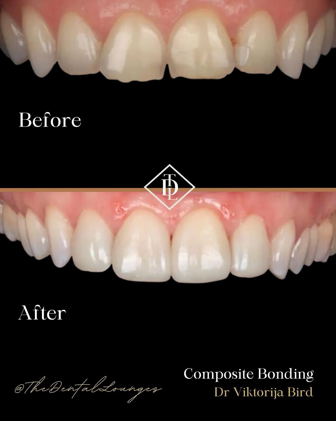Composite bonding fixing gaps and edges, Wimbledon