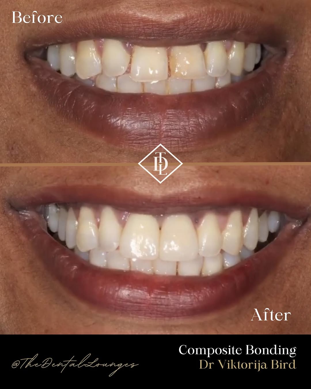 Cosmetic finish case at The Dental Lounges Wimbledon
