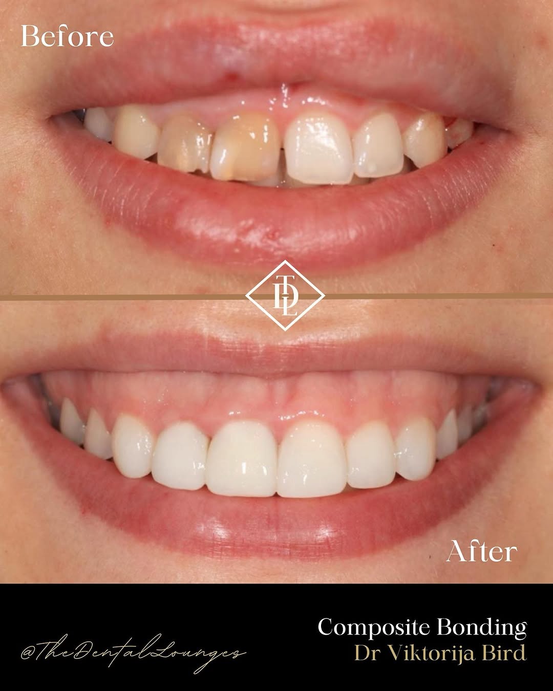 Composite bonding results before and after, Wimbledon