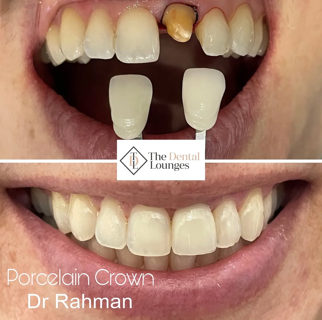 Porcelain crown restoration before and after, Wimbledon