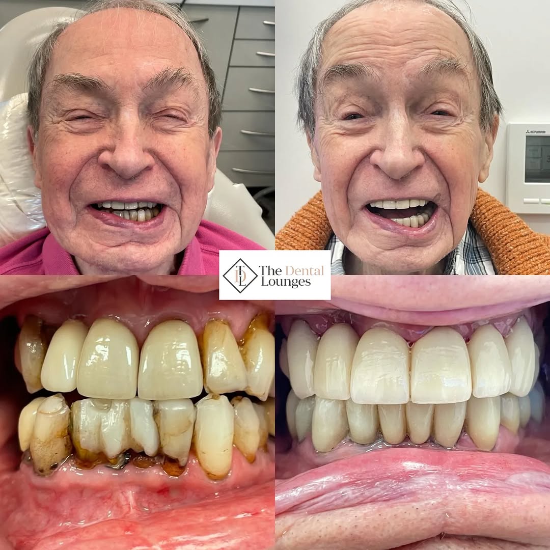 Crown bridge and veneer treatment, Wimbledon