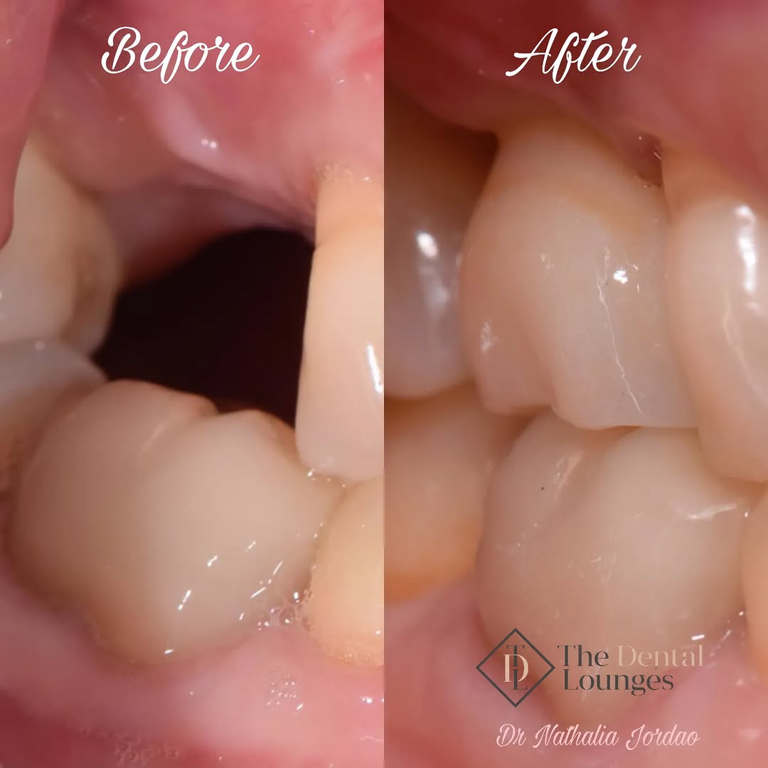 Front tooth dental implant before and after, Wimbledon