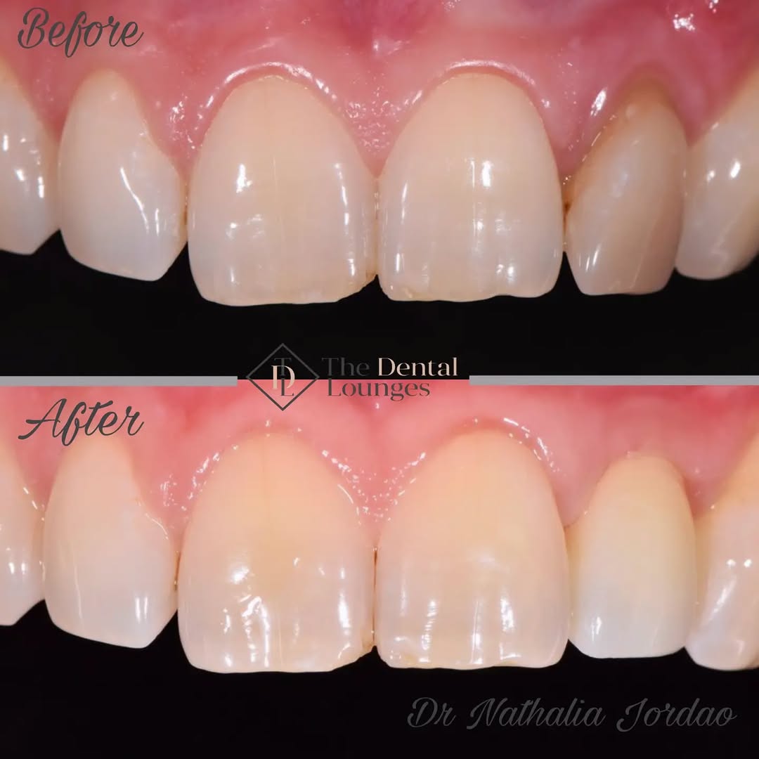 Dental implant natural result before and after, Wimbledon