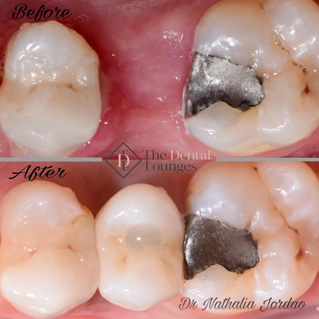 Dental implant tooth replacement before and after, Wimbledon