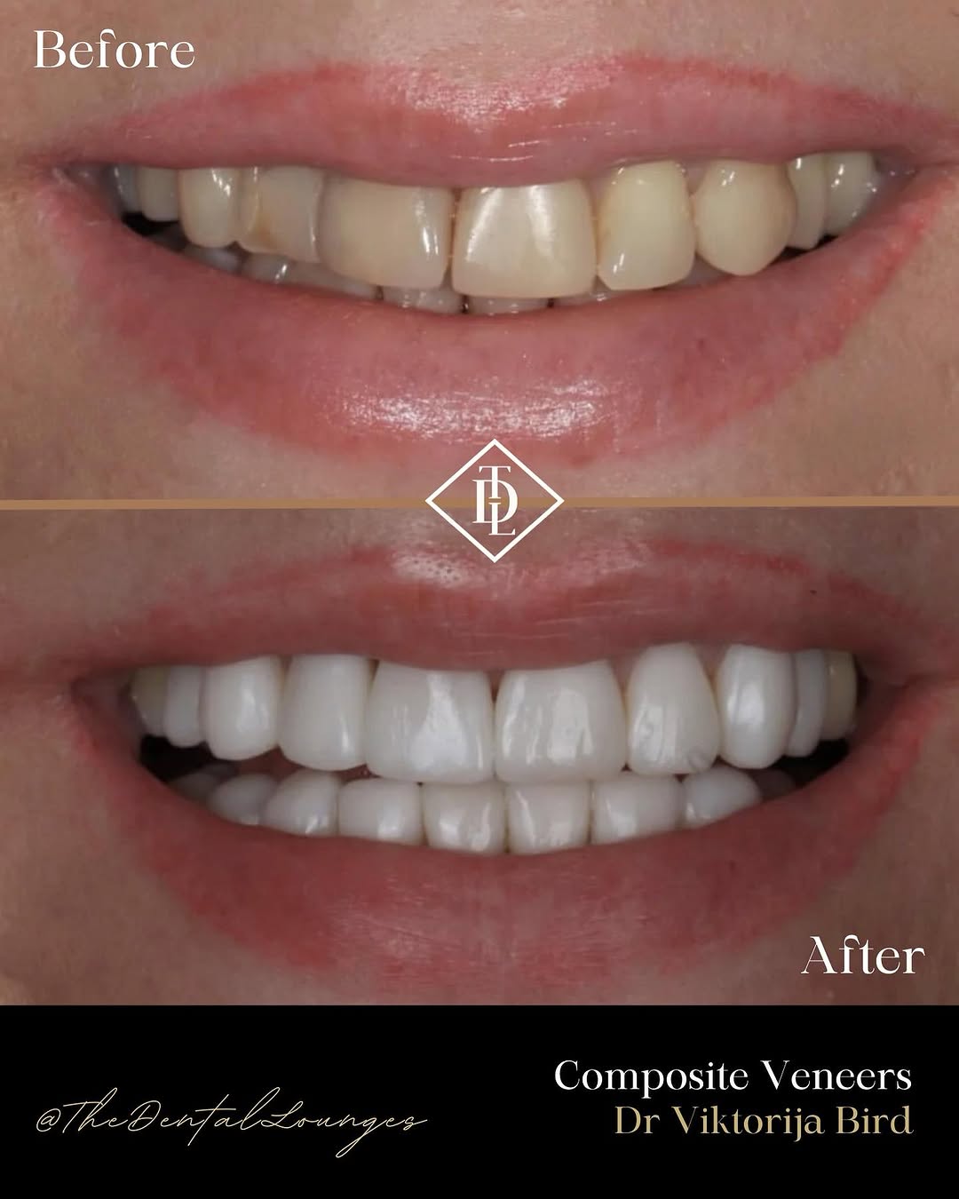 Bespoke composite veneers before and after, Wimbledon
