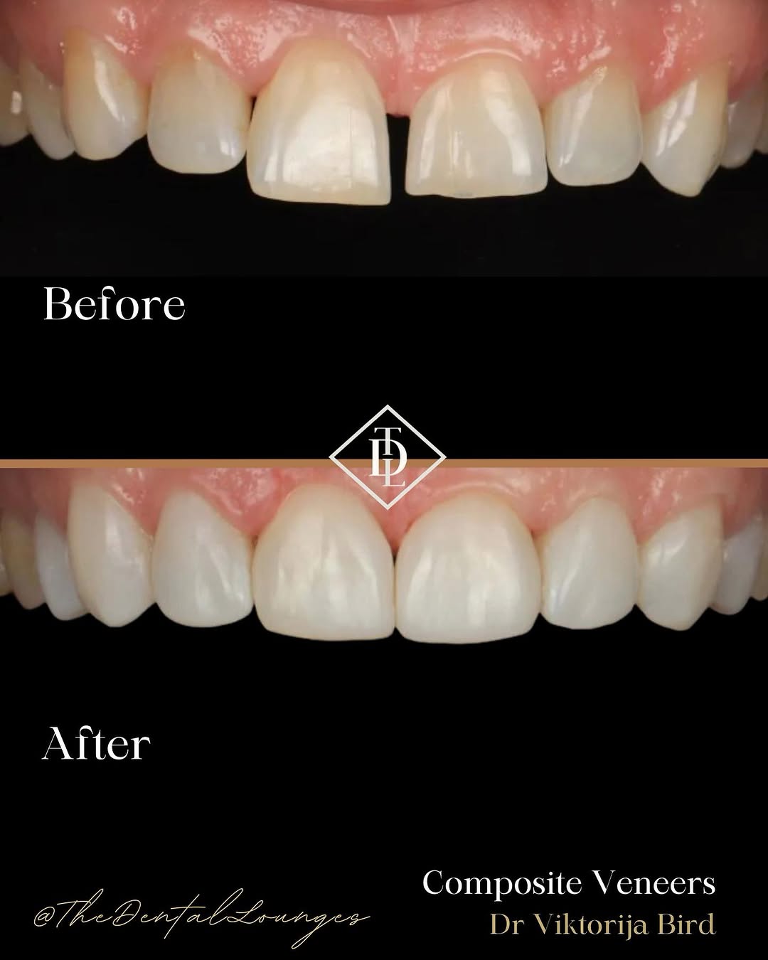 Composite veneers result, Wimbledon
