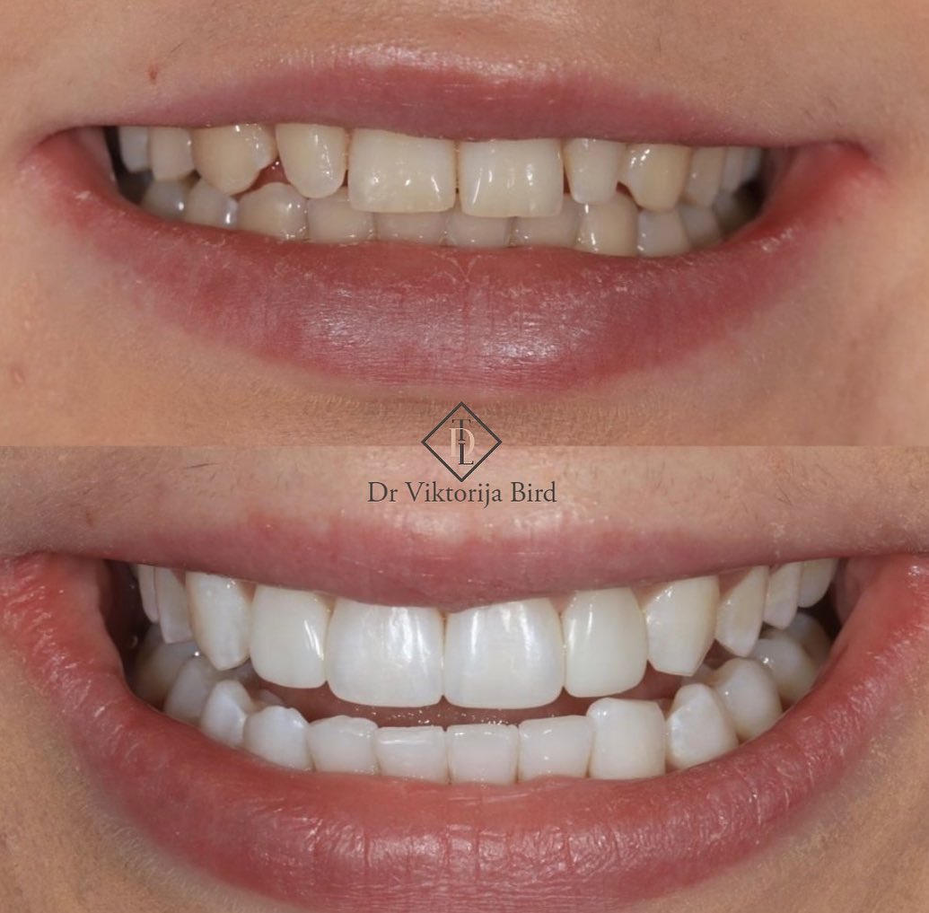 Whitening + bonding case at The Dental Lounges Wimbledon