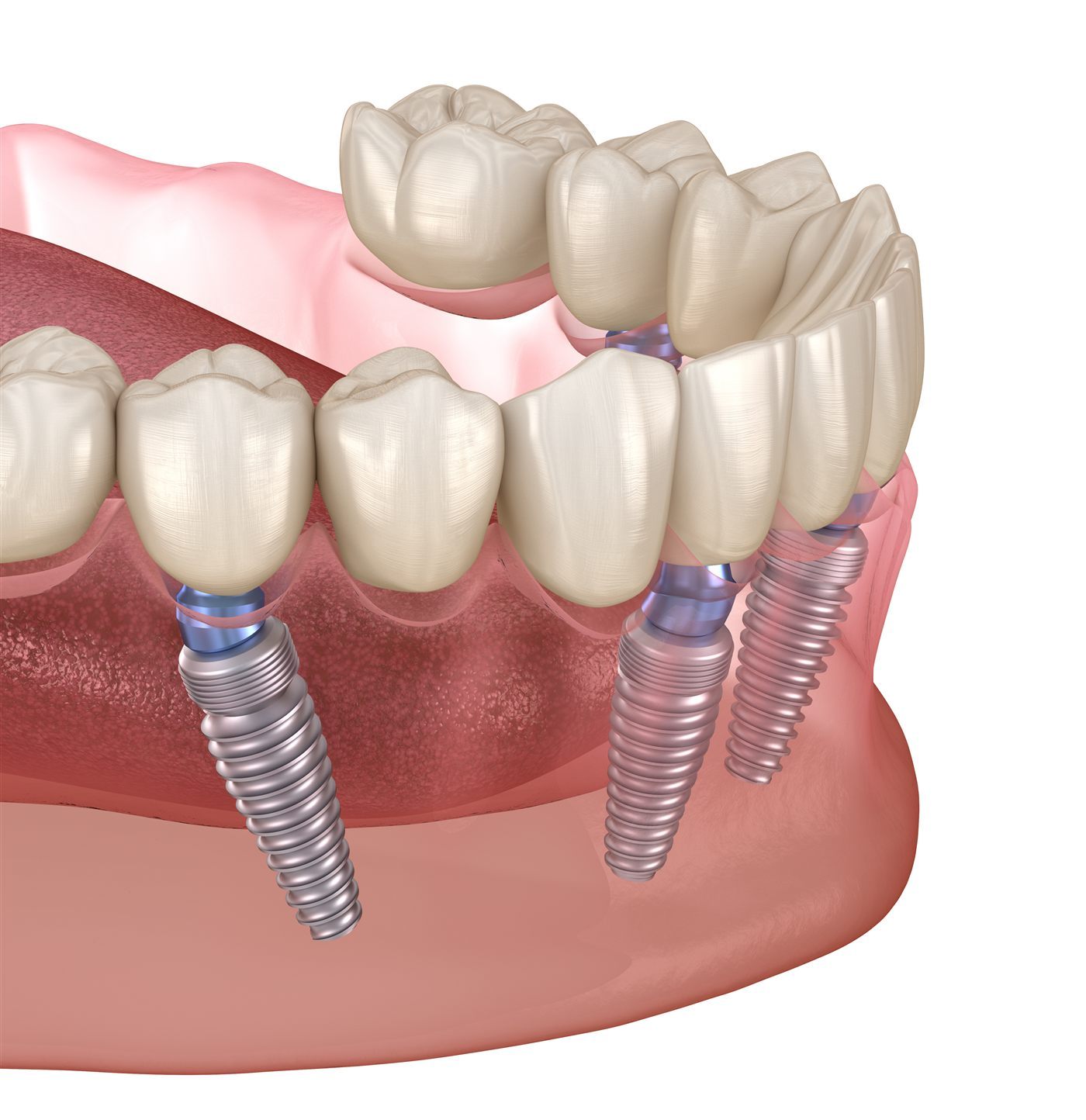 How Much Do Dental Implants Cost in Wimbledon? Honest 2026 Pricing Guide